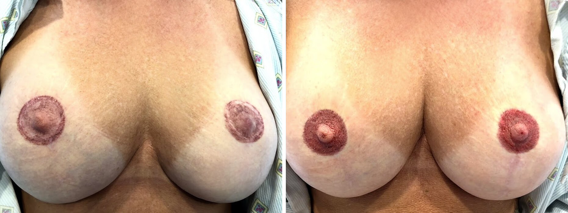 Areola Pigmentation Restoration - Before and After